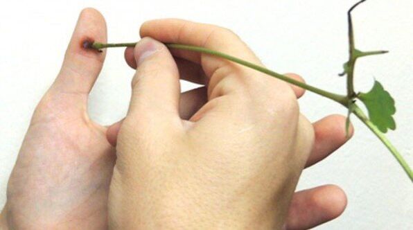 Cauterizácia papilómu na prste šťavou z celandínu