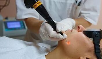 Účinný postup na odstránenie papilómu na tvári laserom