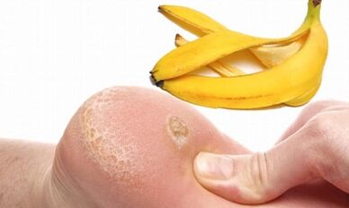 Banánová šupka na spracovanie plantárnych bradaviek