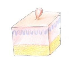 ako sa zbaviť papilómu na tele