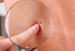 dôvody pre výskyt papilómov na ľudskom tele