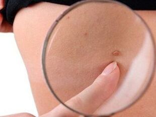Papilóm na tele tehotnej ženy